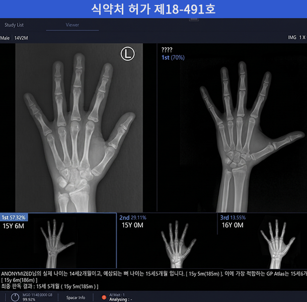 성장판 AI 판독 엑스레이